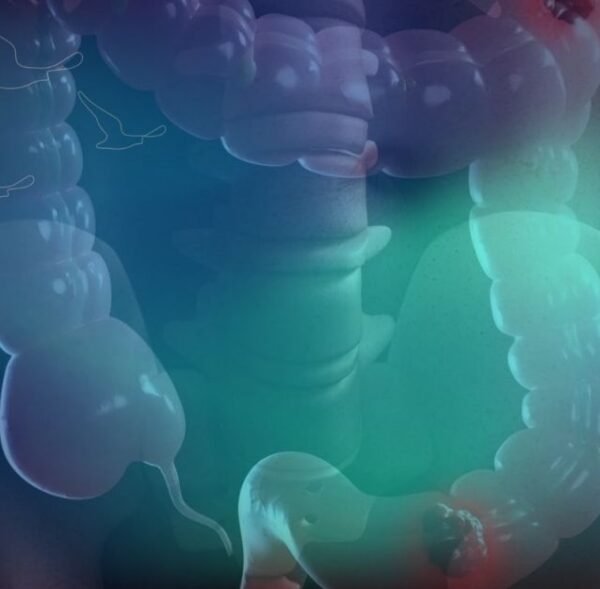 klinist- Psödomiksoma peritonei (2) klinist- Psödomiksoma peritonei (2)