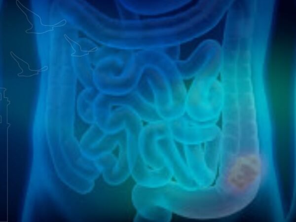 psödomiksoma peritonei nedir