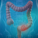 Kolorektal Nedir? Kolorektal Ne Demek, Kolorektal Karsinom Nedir? | İstanbul