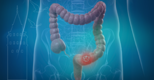 kolorektal nedir, karsinom ne demek