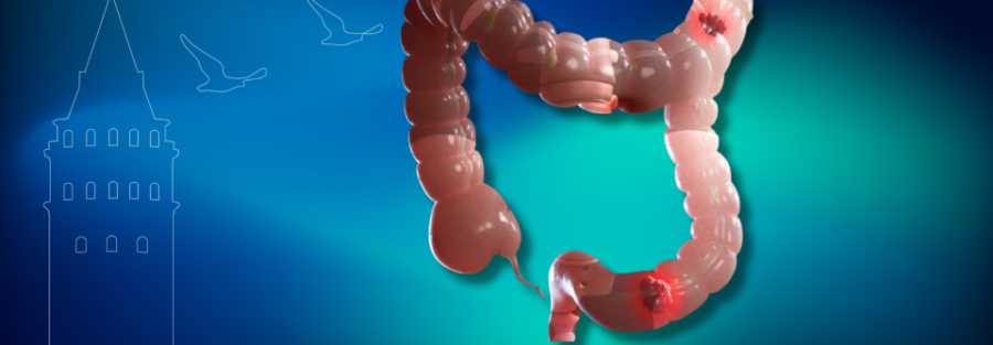 kolorektal kanser nedir