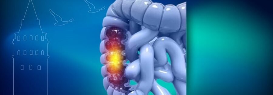 Rektum Kanseri