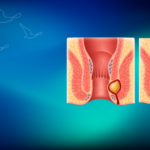 Anal Fistül İle Anal Fissür Arasındaki Fark | Prof. Dr. İlknur Erenler Bayraktar